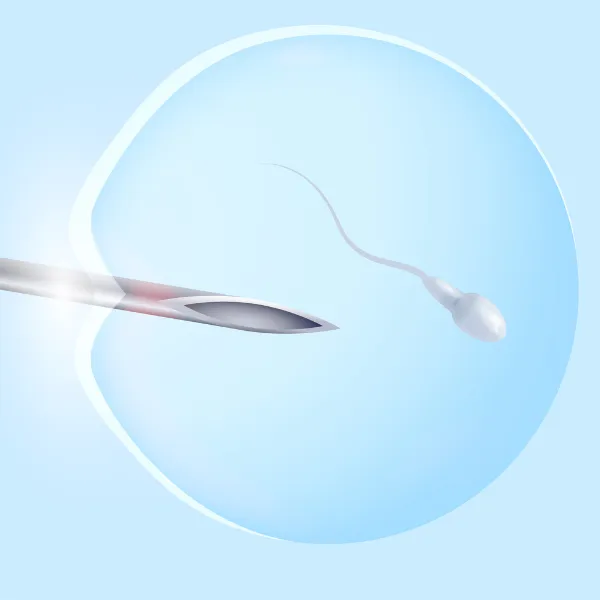 宫腔内人工授精（IUI）